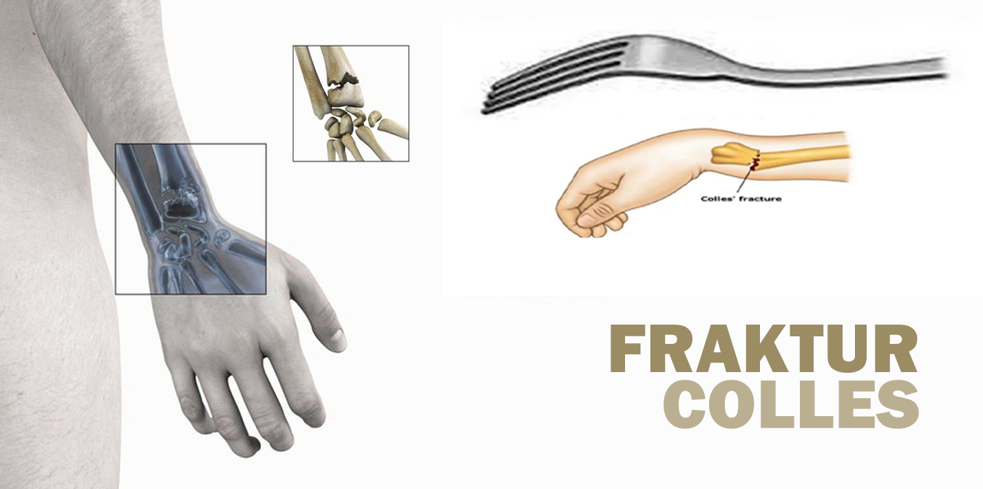 Mengenal Fraktur Colles, Fraktur Dengan Insiden Tertinggi Kedua